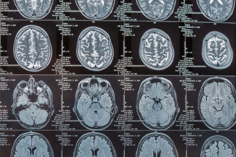 MRI images of a brain.