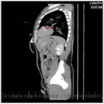 The needle in the man's heart detected via CT scan.
