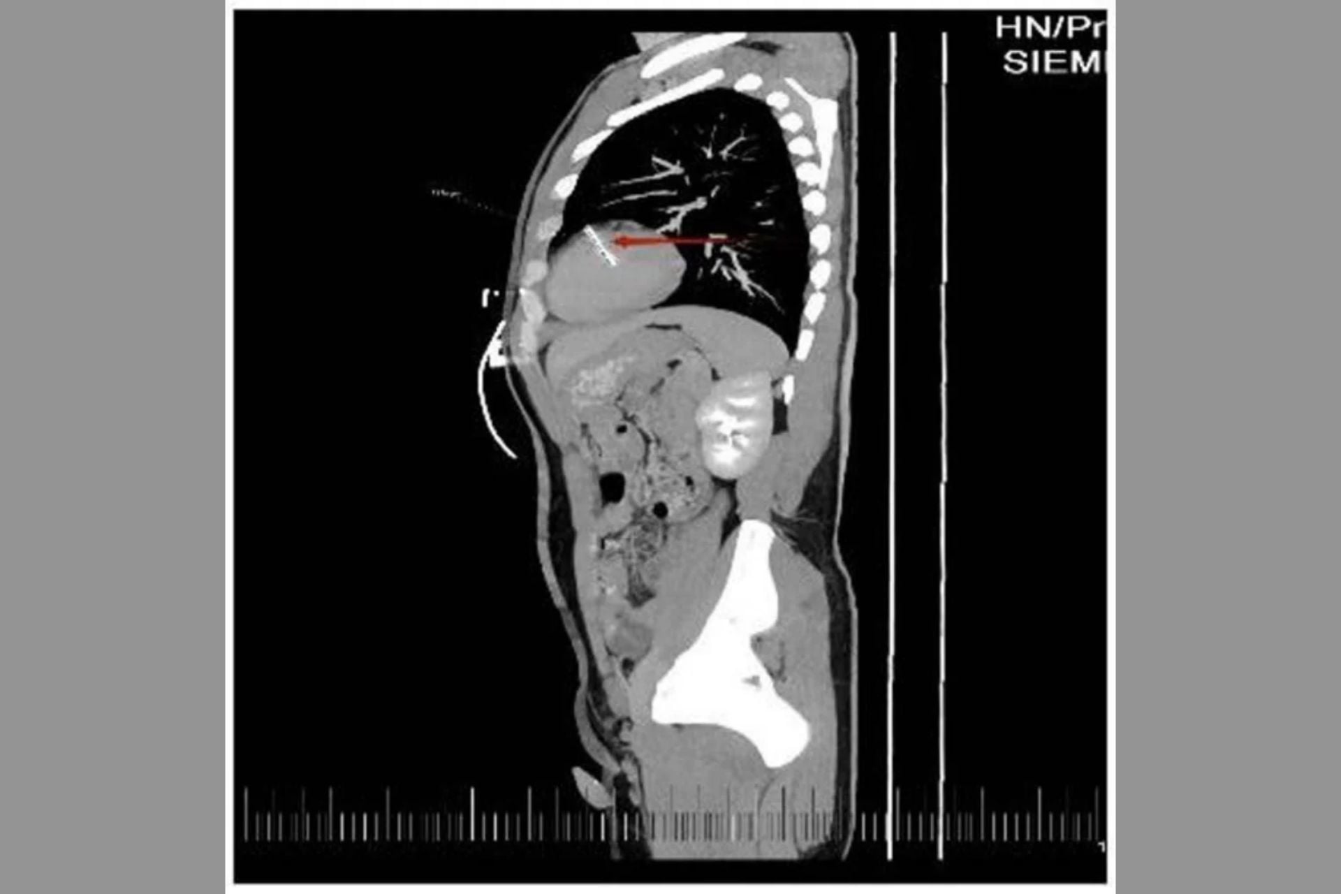 The needle in the man's heart detected via CT scan.