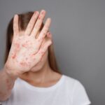 A girl showing the signs of measles.