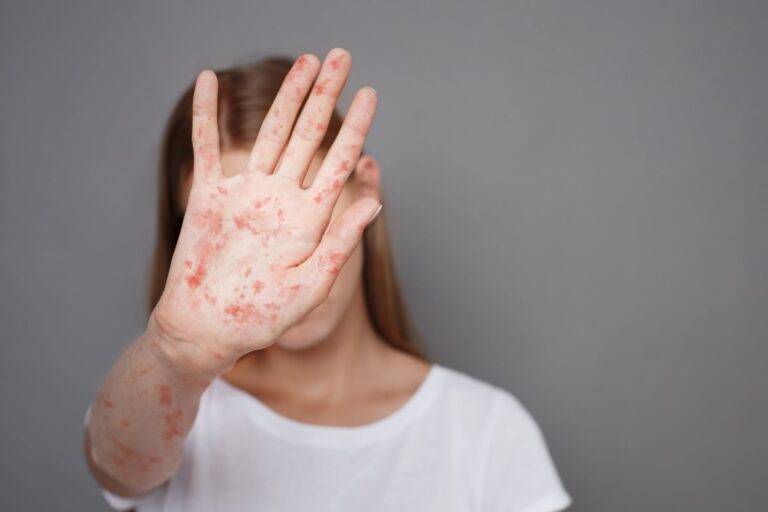 A girl showing the signs of measles.