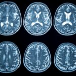 A MRI scan of blood vessels in the brain. Strokes are caused by insufficient blood supply and oxygen to the brain.