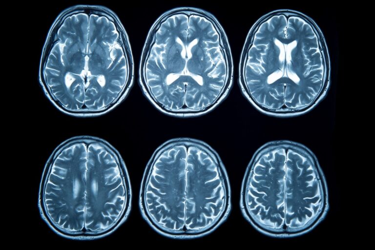 A MRI scan of blood vessels in the brain. Strokes are caused by insufficient blood supply and oxygen to the brain.