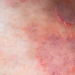 An example of ringworm infection.