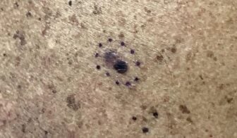 melanoma-lesion-336x196-1 Melanoma Lesion